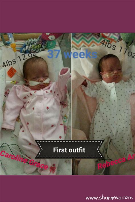 Mono Mono Twins: Caroline and Rebecca's Story - Shann Eva's Blog