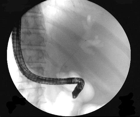 Air Cholangiogram A New Technique For Biliary Imaging During Ercp Gastrointestinal Endoscopy