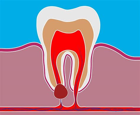 Wisdom Tooth Cyst On Gum