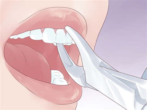 How To Protect A Chipped Tooth With Pictures Wikihow