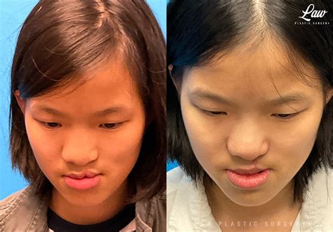 Cleft Lip Repair Secondary And Adult Before And After Photos Law Plastic Surgery