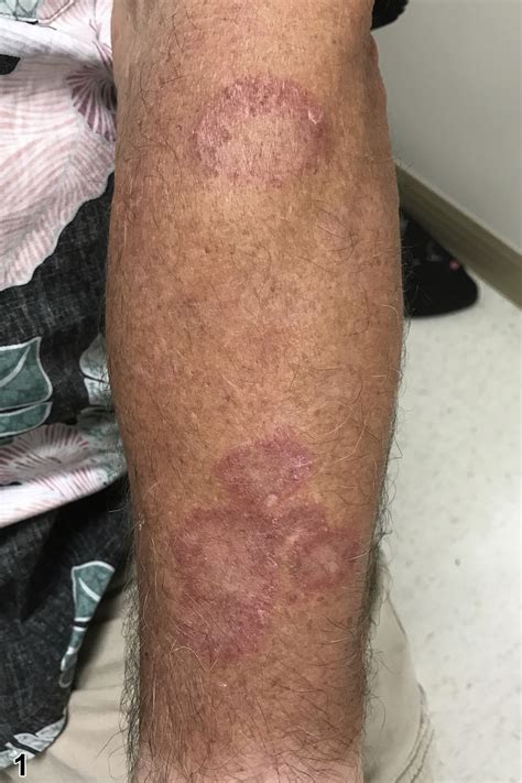 Annular Erythematous Plaques In The Marianas Jaad Case Reports