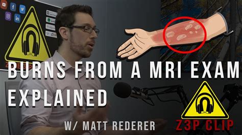 Z3p Clips Mri Burns Youtube