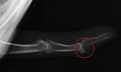 Avulsion Fracture - Rock and Ice