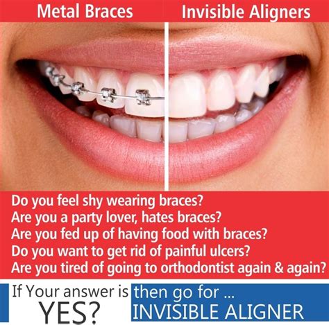 How Much Is Invisalign Braces