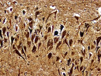 Neurofibrillary Tangles