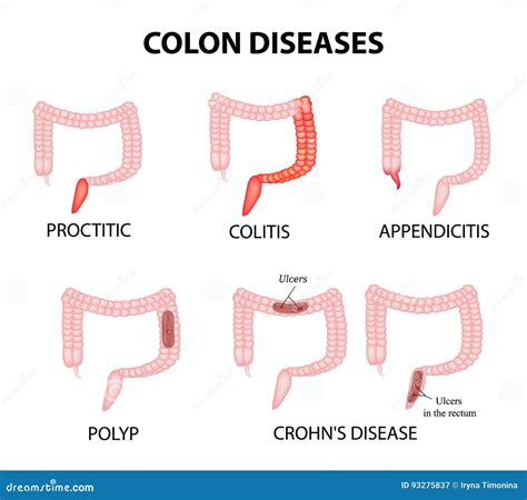 Rectal Polyps Symptoms