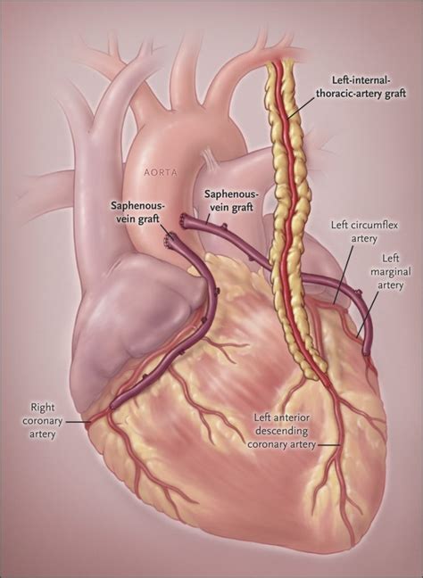 Coronary Artery Bypass Surgery In Iran | Medpersia Medical Tourism