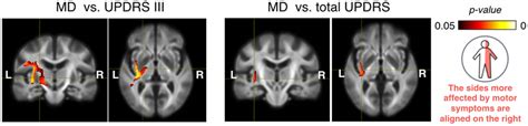 Positive Correlation Between DTI Metrics FA And MD And Clinical