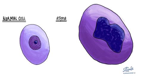 Atypia Mypathologyreportca