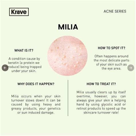 What's The Difference: Whiteheads, Milia, Fungal Acne? | Consejos para ...