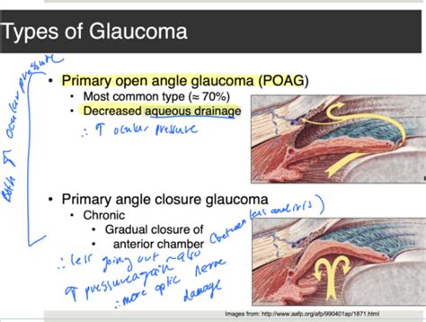 Glaucoma Flashcards Quizlet