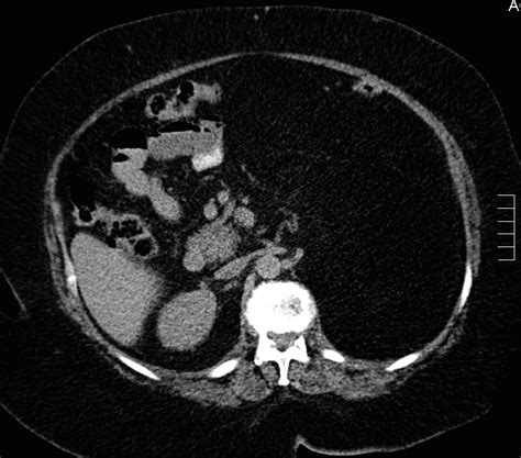 Retroperitoneal Liposarcoma Radiology At St Vincents University