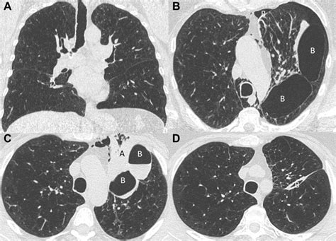 Intralobar Bullae After Endobronchial Valve Treatment | COPD