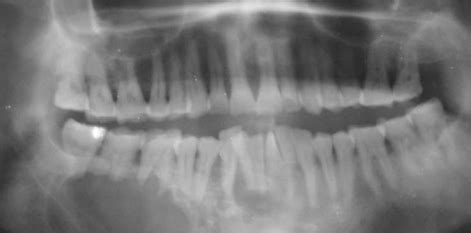 Panoramic Radiograph Shows Multilocular Radiolucent Lesion In The Right