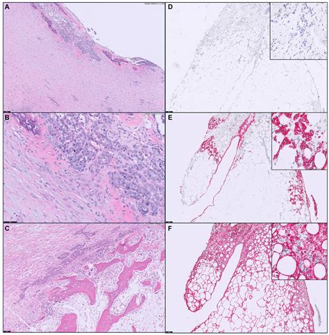 Carcinomatosis Peritoneal Con Desmoplasia Y Metaplasia