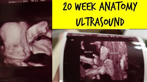 20 Week Anatomy Scan Ultrasound