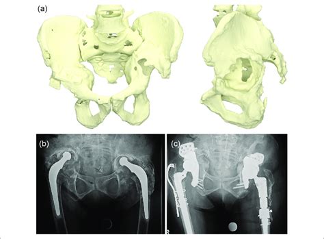 A Preoperative Computed Tomography 3d Reconstruction Model Ap And Download Scientific