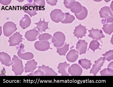 Lab Atlas: Acanthocytes