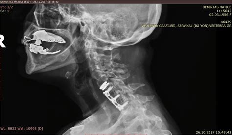 Plain Radiograph Demonstrating Hybrid Construction With Disc Prosthesis Download Scientific