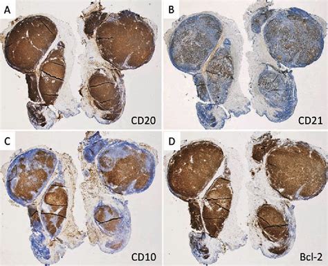 Figure 1 From A Case Of Conjunctival Follicular Lymphoma Mimicking Mucosa Associated Lymphoid