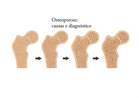 Causas Secundarias Da Osteoporose Cuidado Nbkomputer