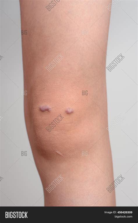 Knee Girl Keloid Scar Image And Photo Free Trial Bigstock