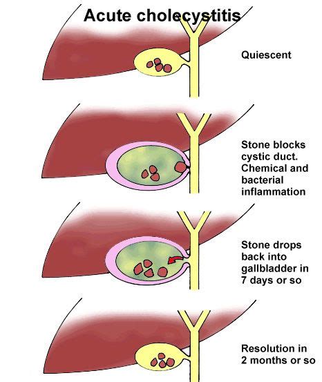 Acute Cholecystitis Pediatric Surgery Medical School Stuff Medical