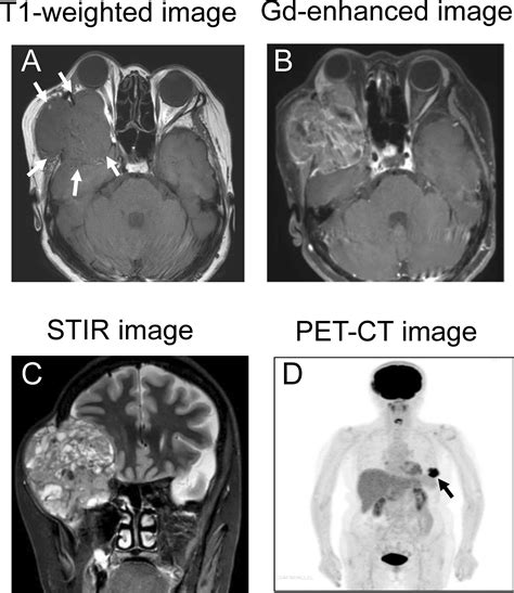 Frontiers Metastatic Orbital Tumor From Breast Ductal Carcinoma With