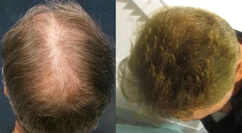 Hair transplant procedure | LA Hair Transplant