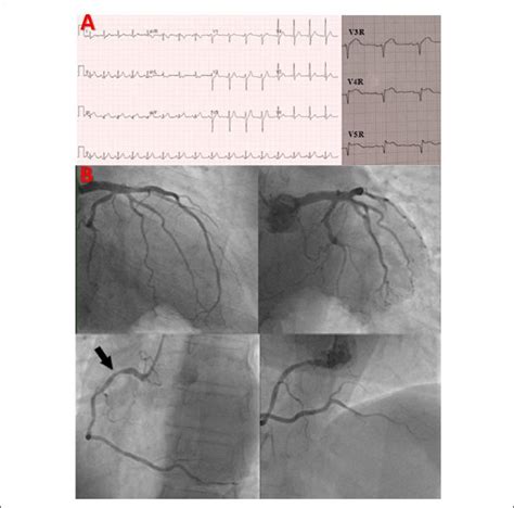 Isolated Right Ventricle Myocardial Infarction Is The Right Ventricle