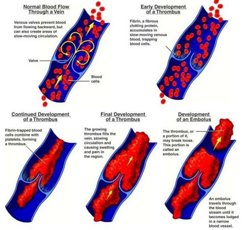 Common Facts of Venous Thromboembolism