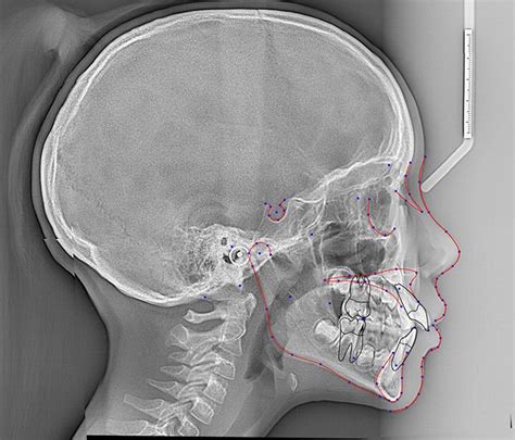 Cephalometric Analysis Based On X Ray Scans Cephx