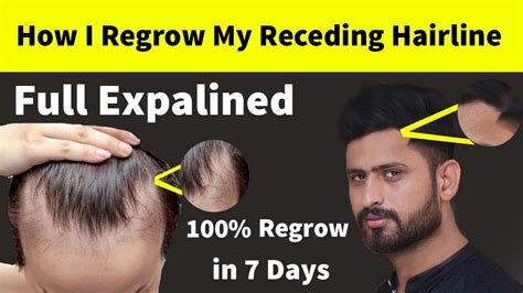 How I Regrow My Receding Hairline Naturally At Home Receding Hairline