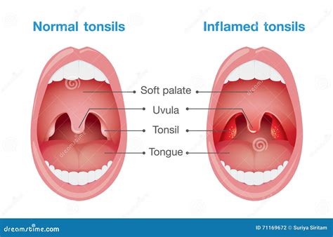 Tonsils Cartoons, Illustrations & Vector Stock Images - 846 Pictures to ...