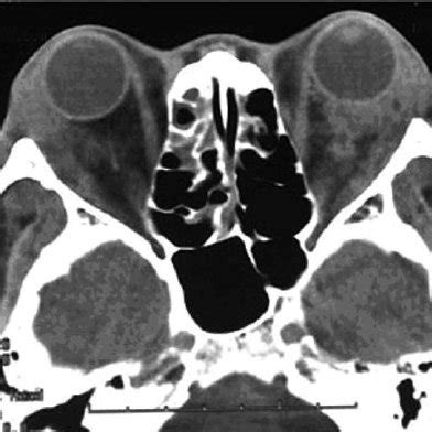 Orbital CT scan showing bilateral tumor invasion. CT scan demonstrates... | Download Scientific ...