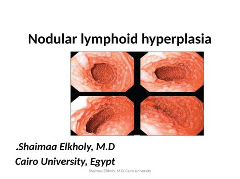 Pdf Nodular Lymphoid Hyperplasia