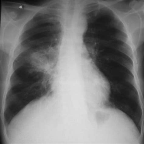 Chest radiography showed right hilar lymphadenopathy | Download Scientific Diagram