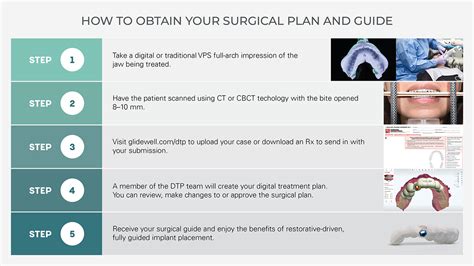 How and Why to Use Guided Implant Surgery | Glidewell