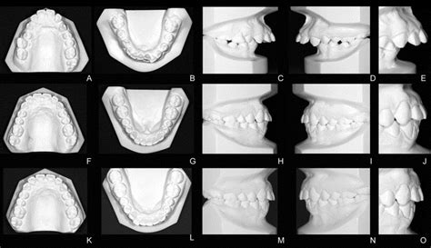 Correction Of Extreme Overjet In 2 Phases American Journal Of