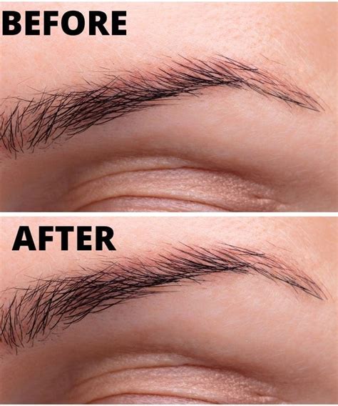 Eyebrow Lift Botox Eyebrow Lift London London Lip Clinic