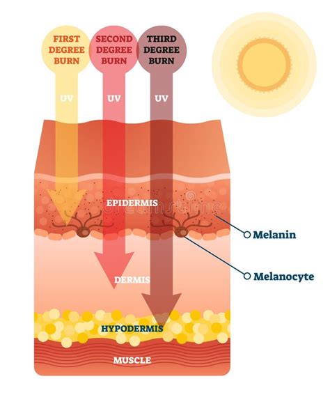 Radiation Skin Damage Stock Illustrations – 344 Radiation Skin Damage ...