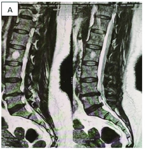 A Preoperative Sagittal Mri Download Scientific Diagram