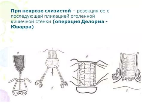 Выпадение прямой кишки презентация онлайн