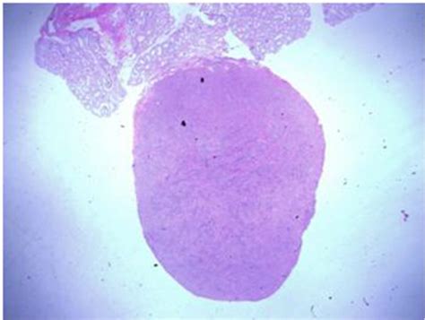 A 17 Year Old Male With A Testicular Fibrothecoma A Case Report