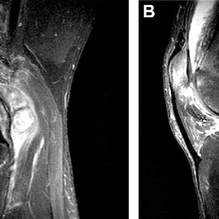 e Sagittal MRI of the right knee. A Extensive synovial proliferation in... | Download Scientific ...