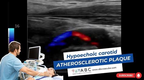 Hypoechoic Carotid Atherosclerotic Plaque Youtube