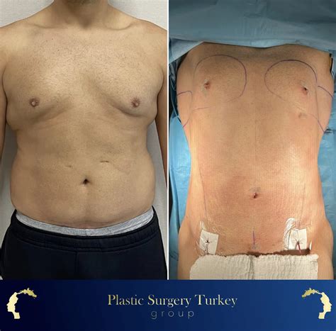 Abdominoplasty In Turkey Affordable Tummy Tuck Procedures Plastic