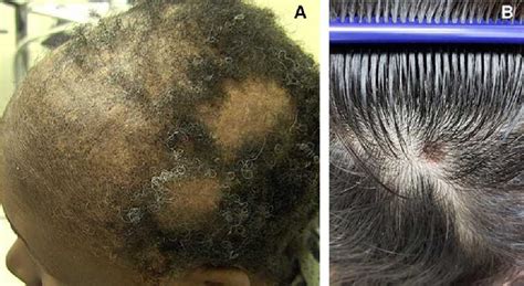 Figure 1 from Recent Insight on the Management of Lupus Erythematosus ...