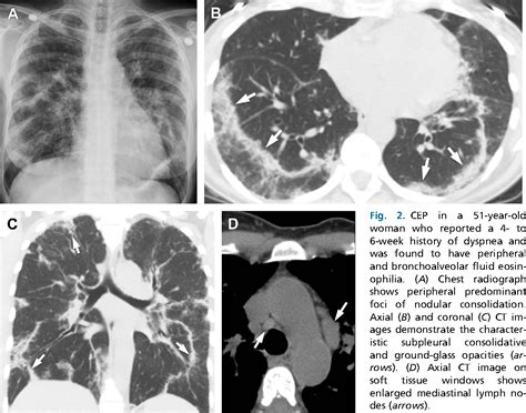 Figure From Imaging Of Eosinophilic Lung Diseases Semantic Scholar